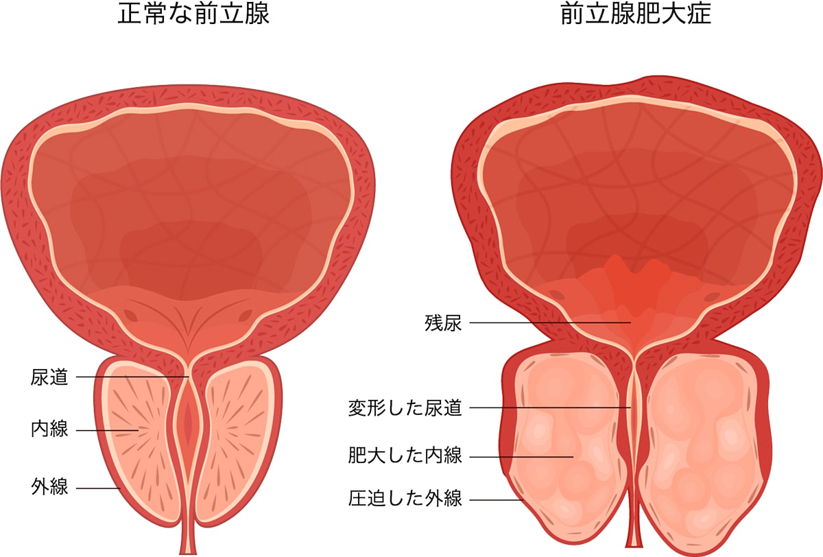 前立腺肥大症と正常な前立腺の比較イラスト